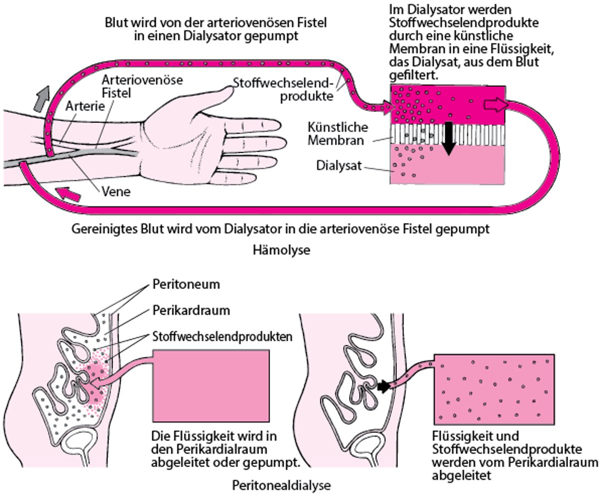 Hämodialyse und Peritonealdialyse im Vergleich