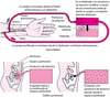 Comparación de la hemodiálisis y la diálisis peritoneal