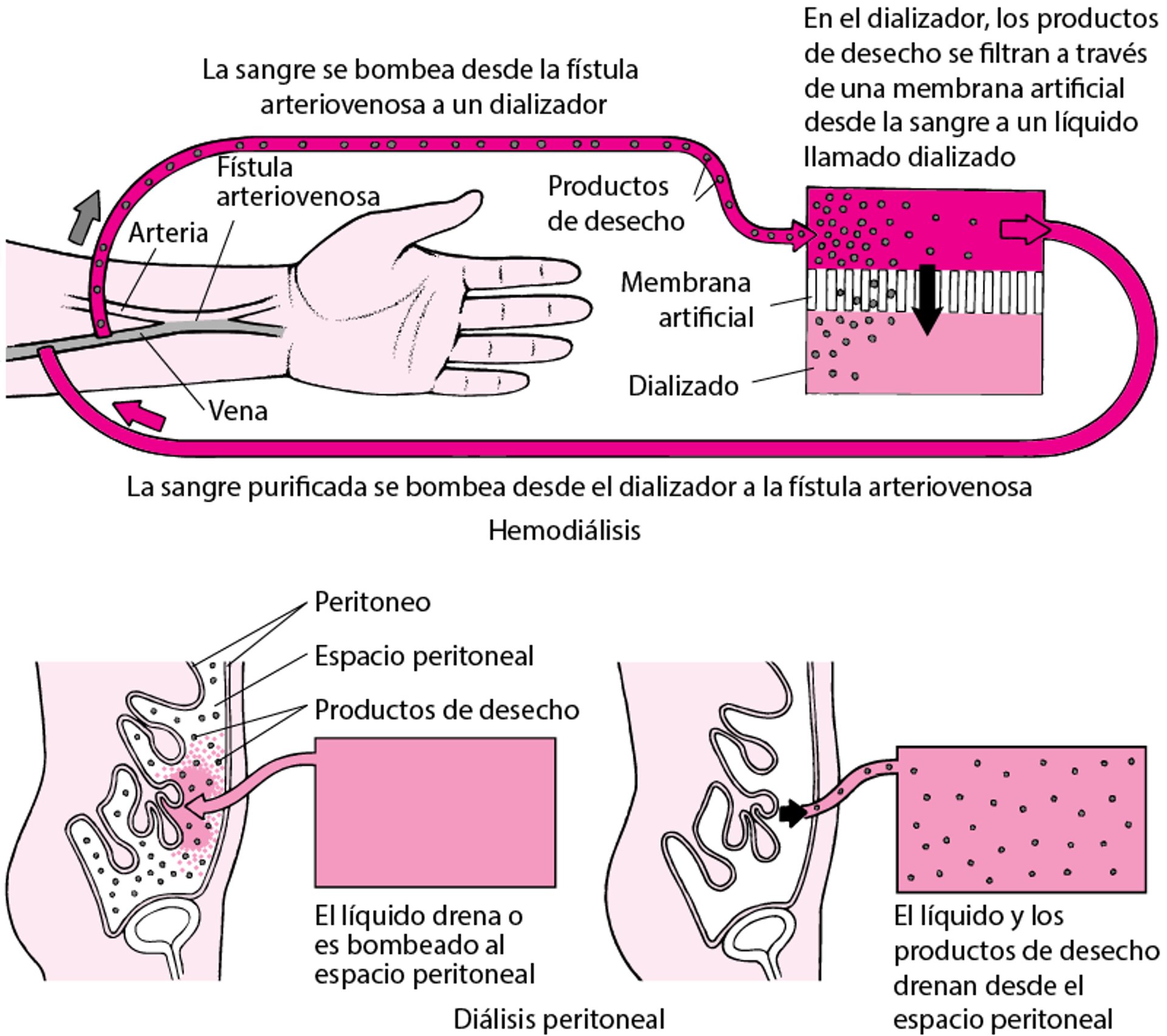 Comparación de la hemodiálisis y la diálisis peritoneal