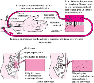 Comparación de la hemodiálisis y la diálisis peritoneal