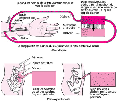 Comparaison entre hémodialyse et dialyse péritonéale