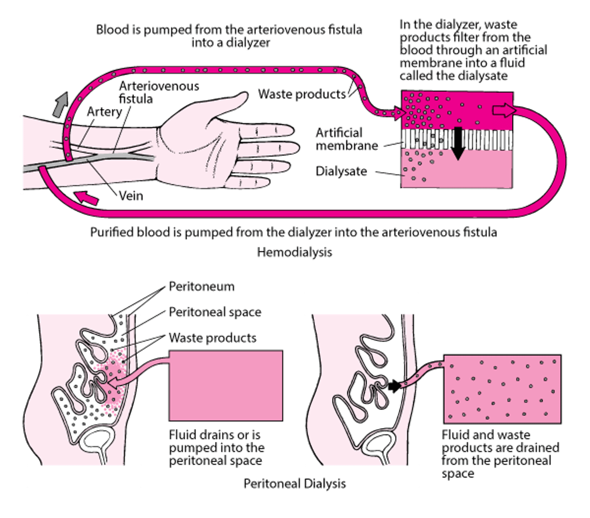 Membandingkan Hemodialisis dengan Dialisis Peritoneal