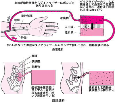 血液透析と腹膜透析の比較