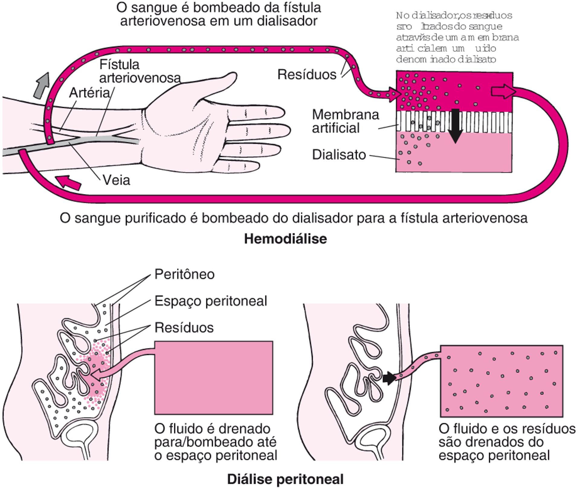 Comparação da hemodiálise com a diálise peritoneal