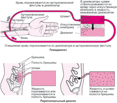 Сравнение гемодиализа с перитонеальным диализом
