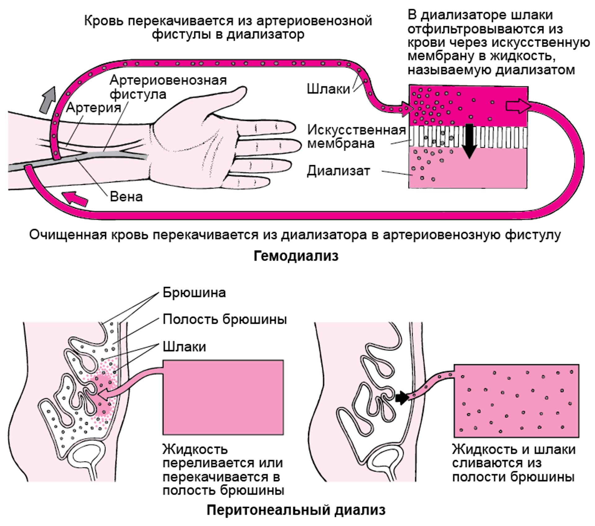 Сравнение гемодиализа с перитонеальным диализом
