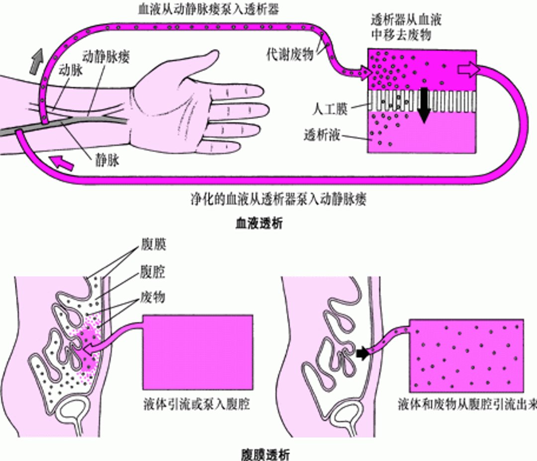 血液透析与腹膜透析的对比
