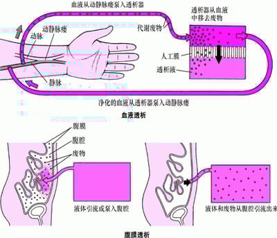 血液透析与腹膜透析的对比