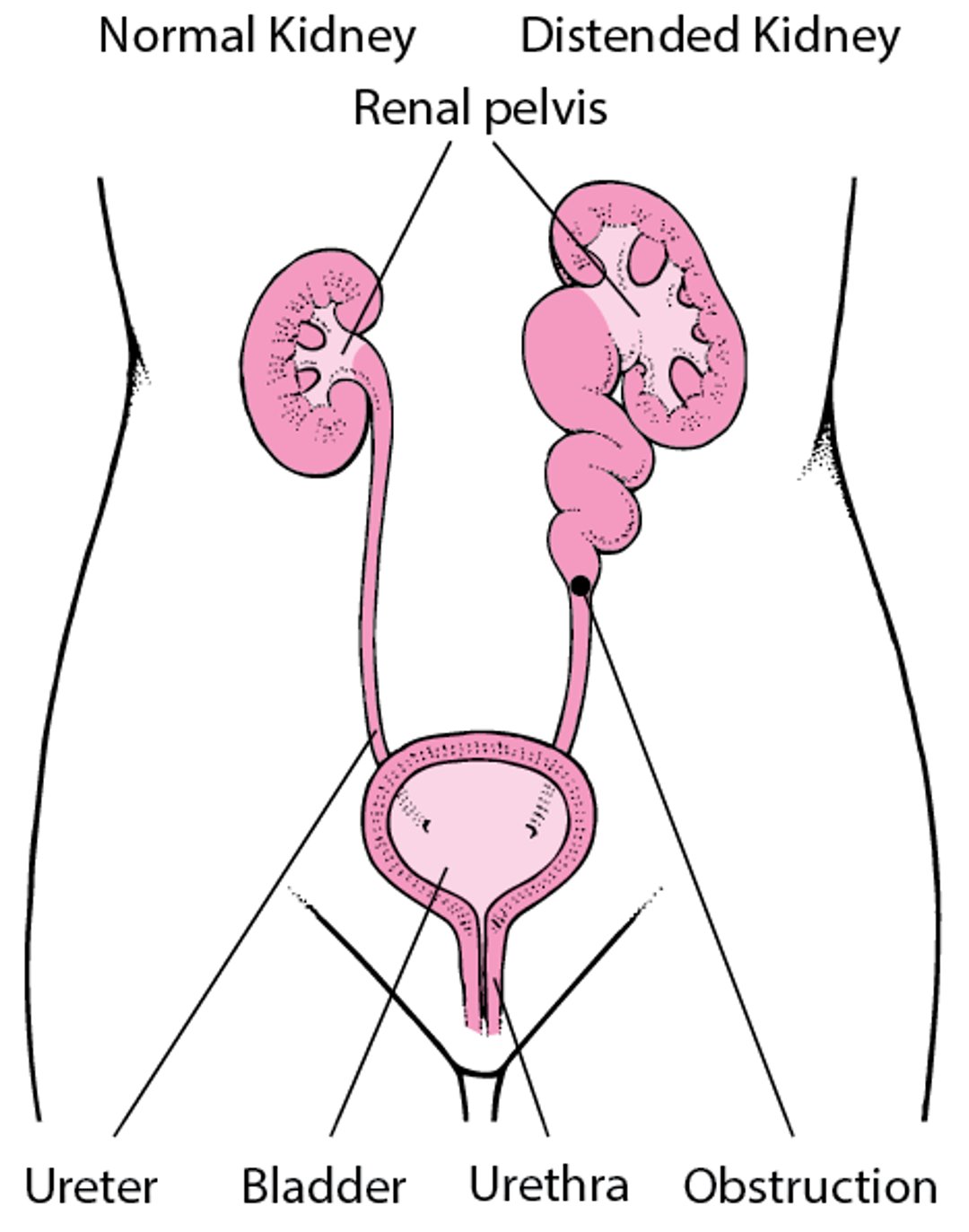 Distended Kidney