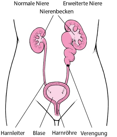 Erweiterte Niere