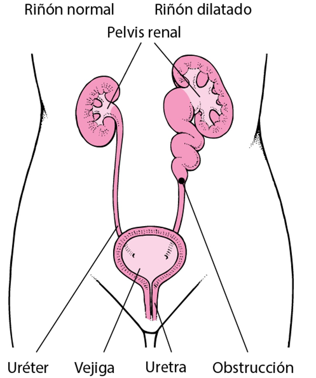 Distensión renal