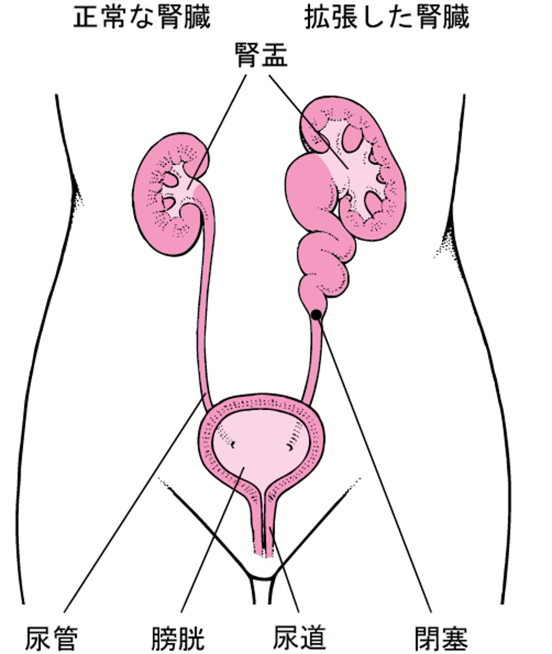 拡張かくちょうした腎臓じんぞう
