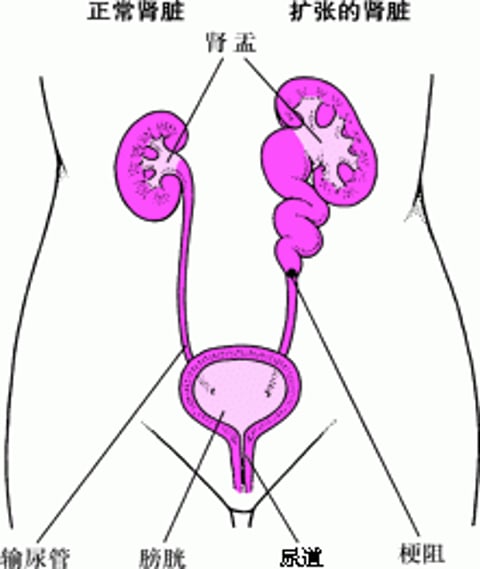 膨胀的肾脏