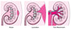 Kidney Injuries: Minor to Severe