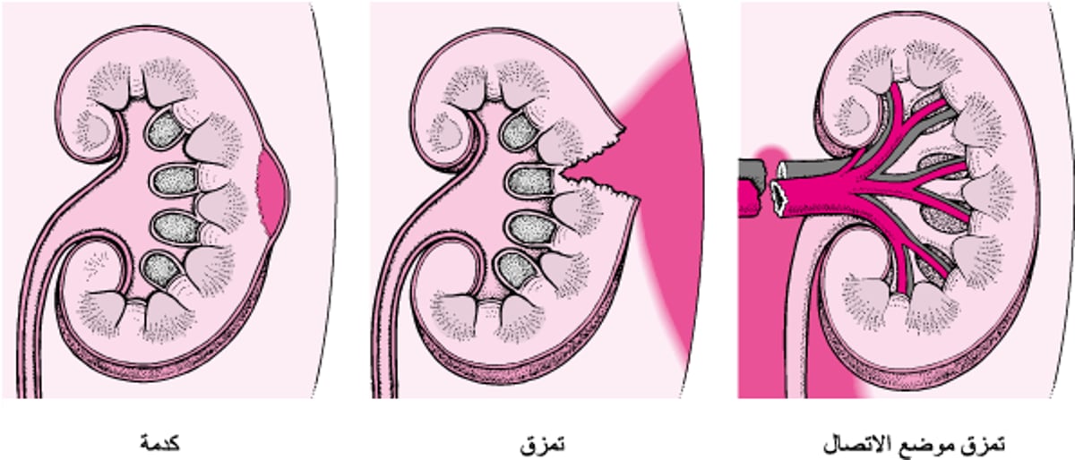 إصابات الكلى: البسيطة إلى الشديدة