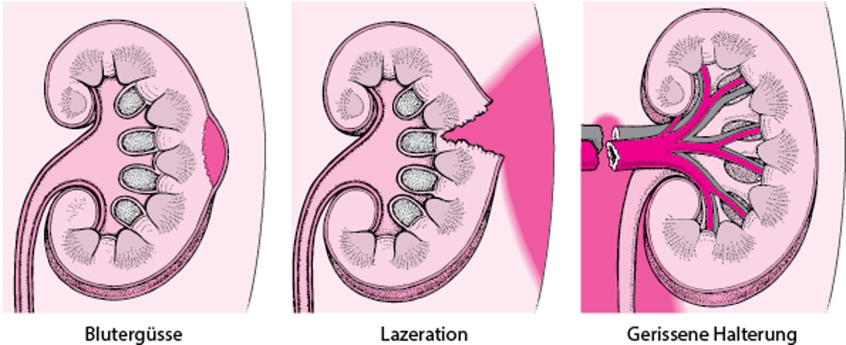 Nierenverletzungen: Leichte bis schwere