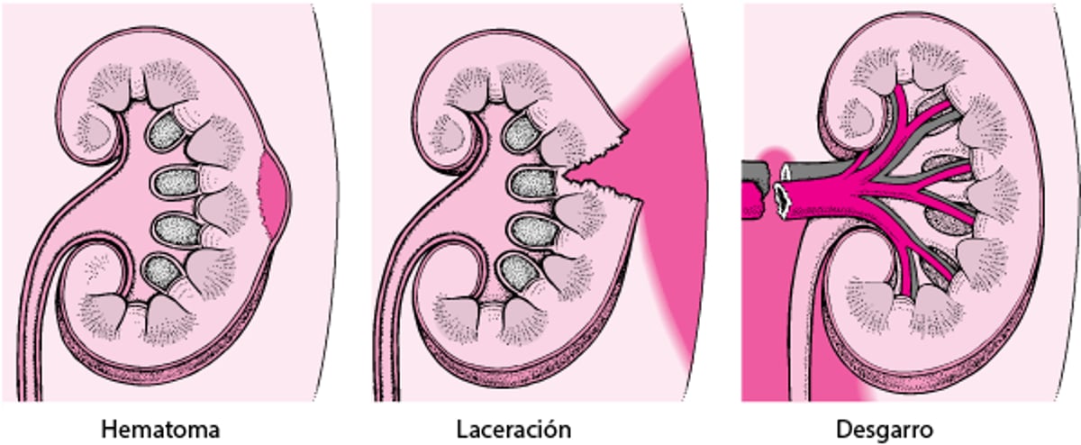 Lesiones del riñón: leves a graves