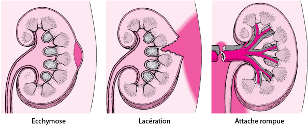 Lésions rénales : légères à sévères