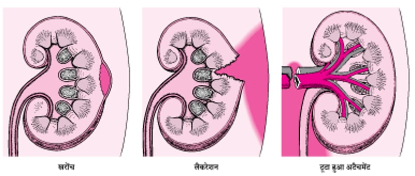 किडनी की चोटें: हल्की से गंभीर तक