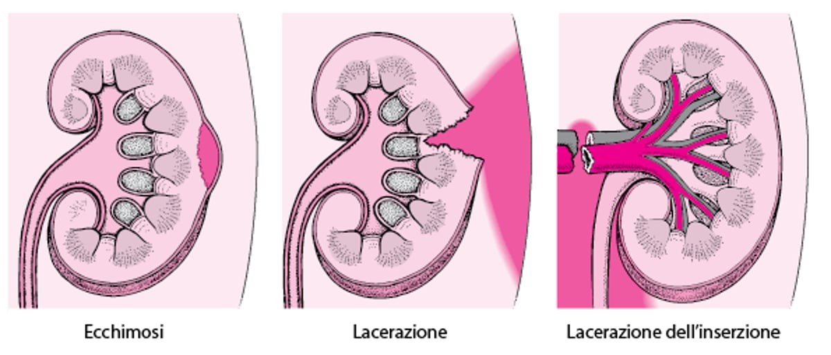 Lesioni renali: da minori a gravi