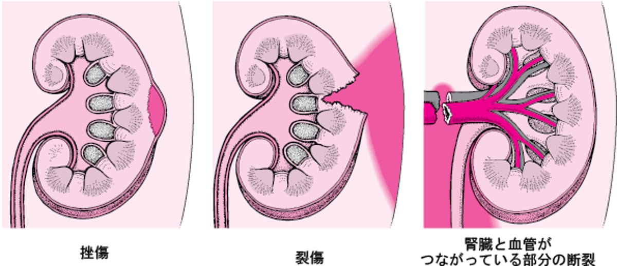 腎外傷：軽度から重度まで