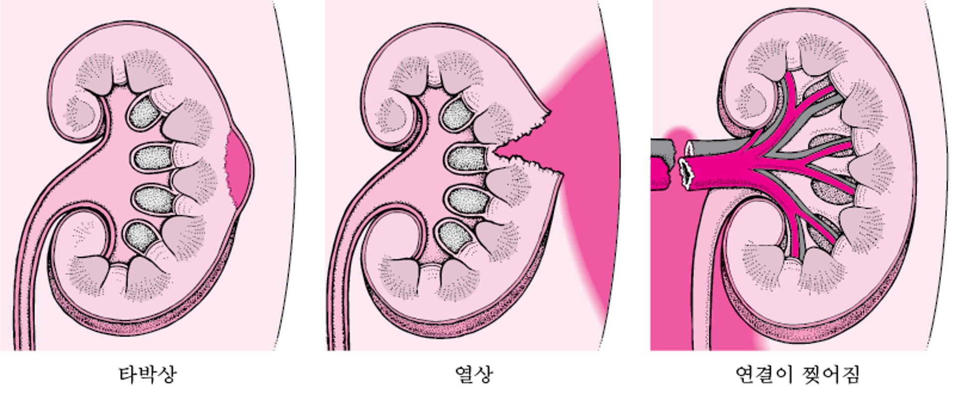 신장 손상: 경증 내지 중증