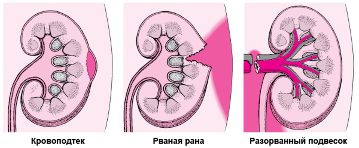 Травмы почек: легкие и тяжелые