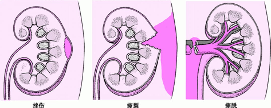 肾脏损伤：轻微到严重