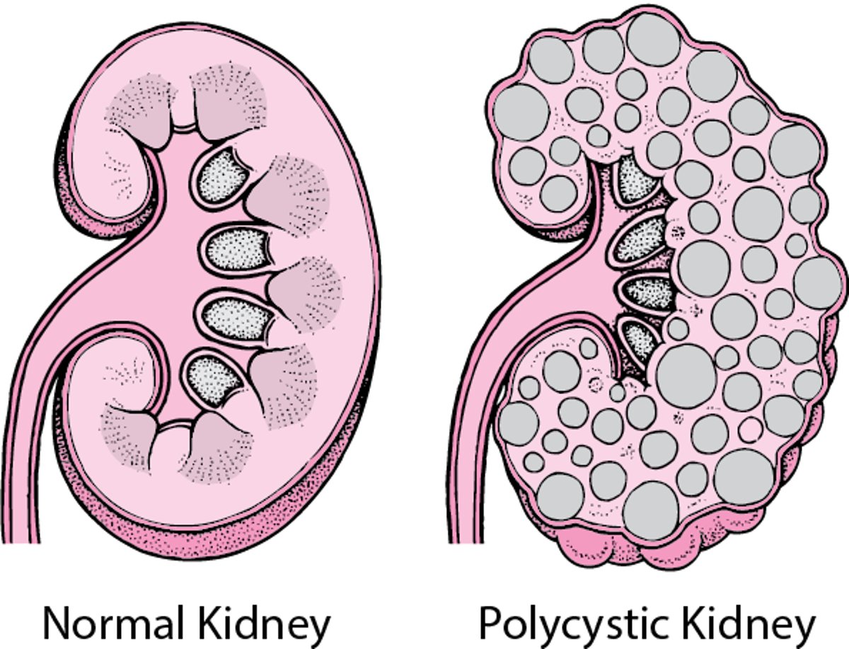 Polycystic Kidney Disease