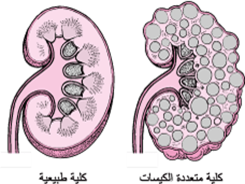 داءُ الكُلَى المُتَعَدِّدَةِ الكيسات