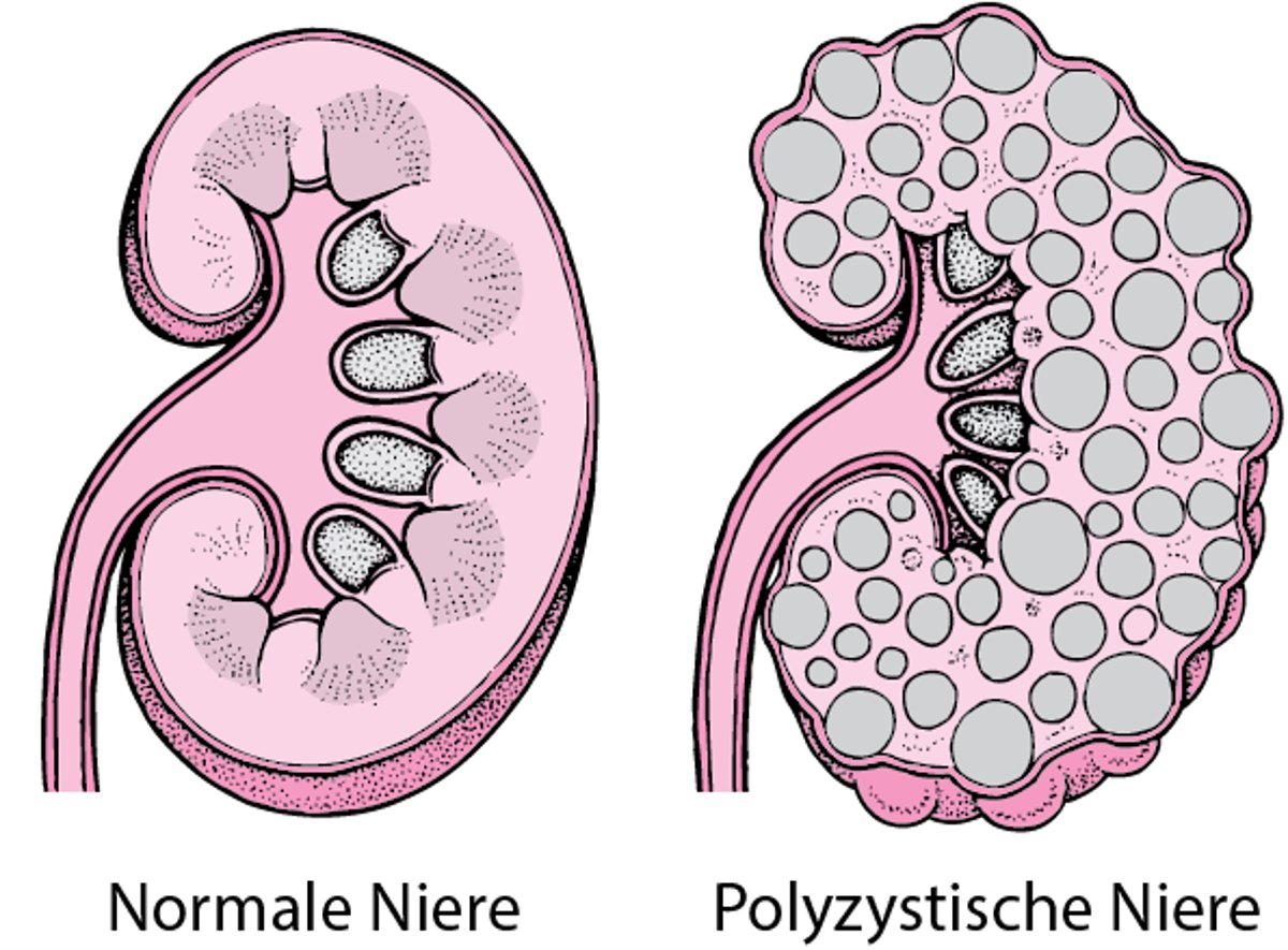 Polyzystische Nierenerkrankung