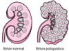 Enfermedad renal poliquística