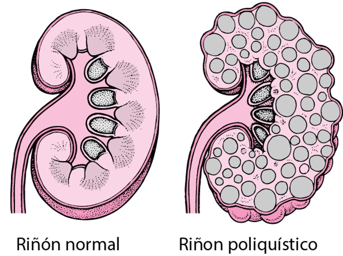 Enfermedad renal poliquística