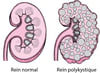 Polykystose rénale