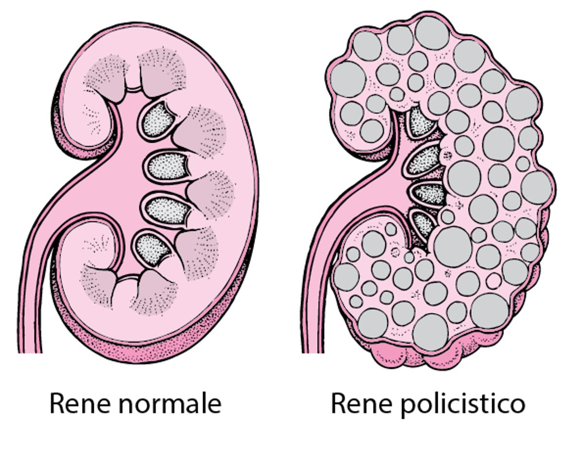 Malattia del rene policistico