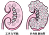 多発性嚢胞腎たはつせいのうほうじん
