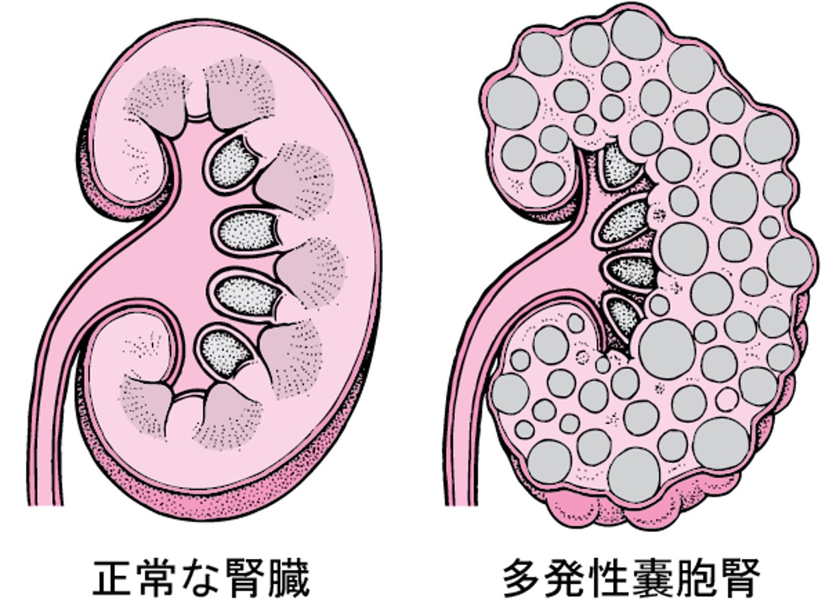 多発性嚢胞腎たはつせいのうほうじん