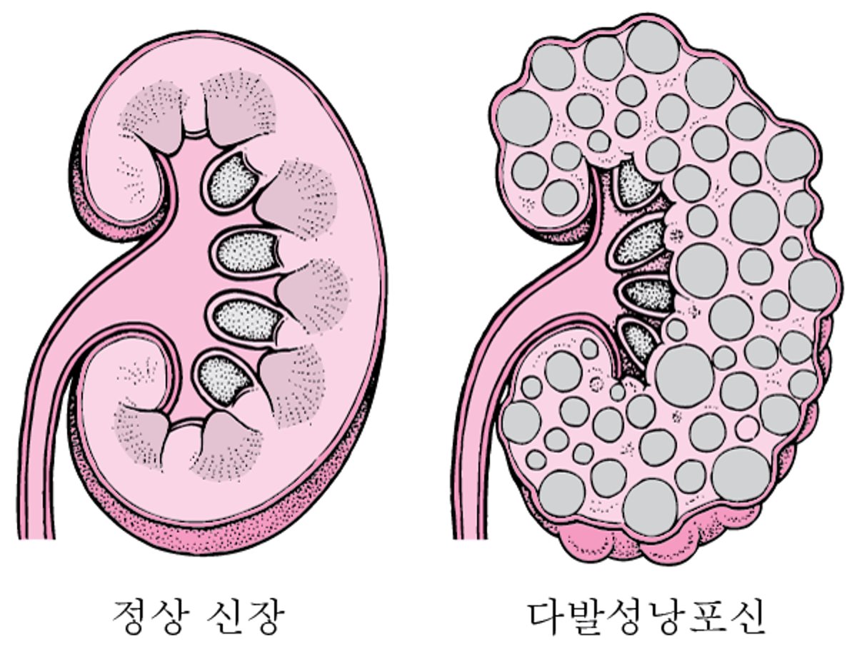 다낭성 신장 질환