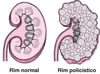 Doença renal policística
