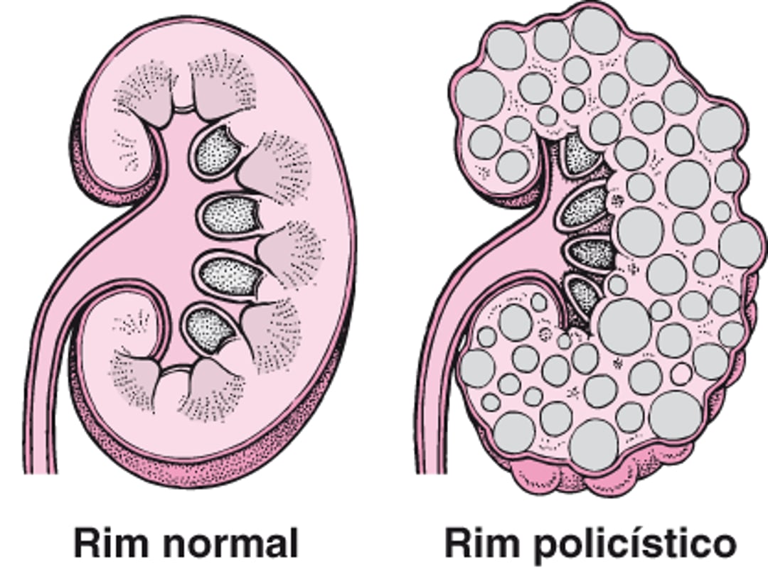 Doença renal policística