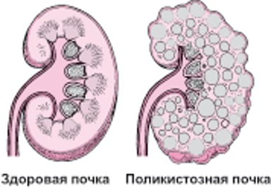 Поликистозная болезнь почек
