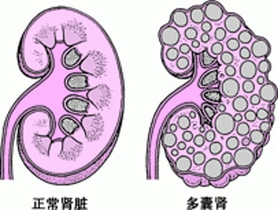 多囊性肾病