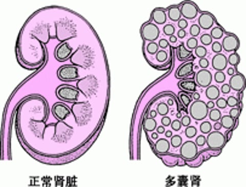 多囊性肾病