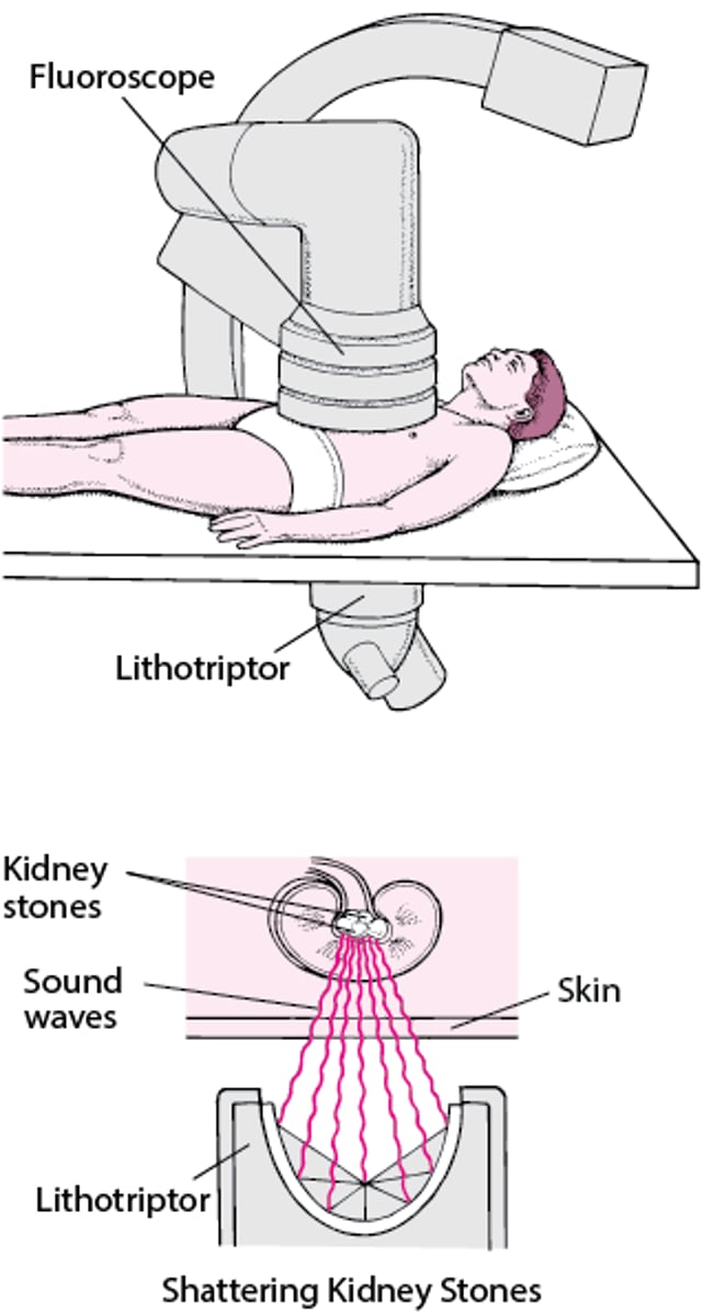 Removing a Stone With Sound Waves