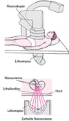 Nierensteinzertrümmerung mit Schallwellen