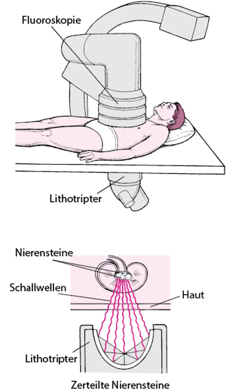 Nierensteinzertrümmerung mit Schallwellen