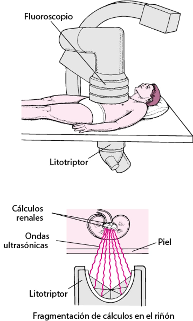 Eliminación de un cálculo mediante ondas ultrasónicas