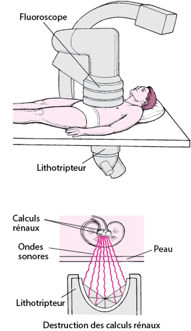 Élimination d’un calcul par des ondes sonores
