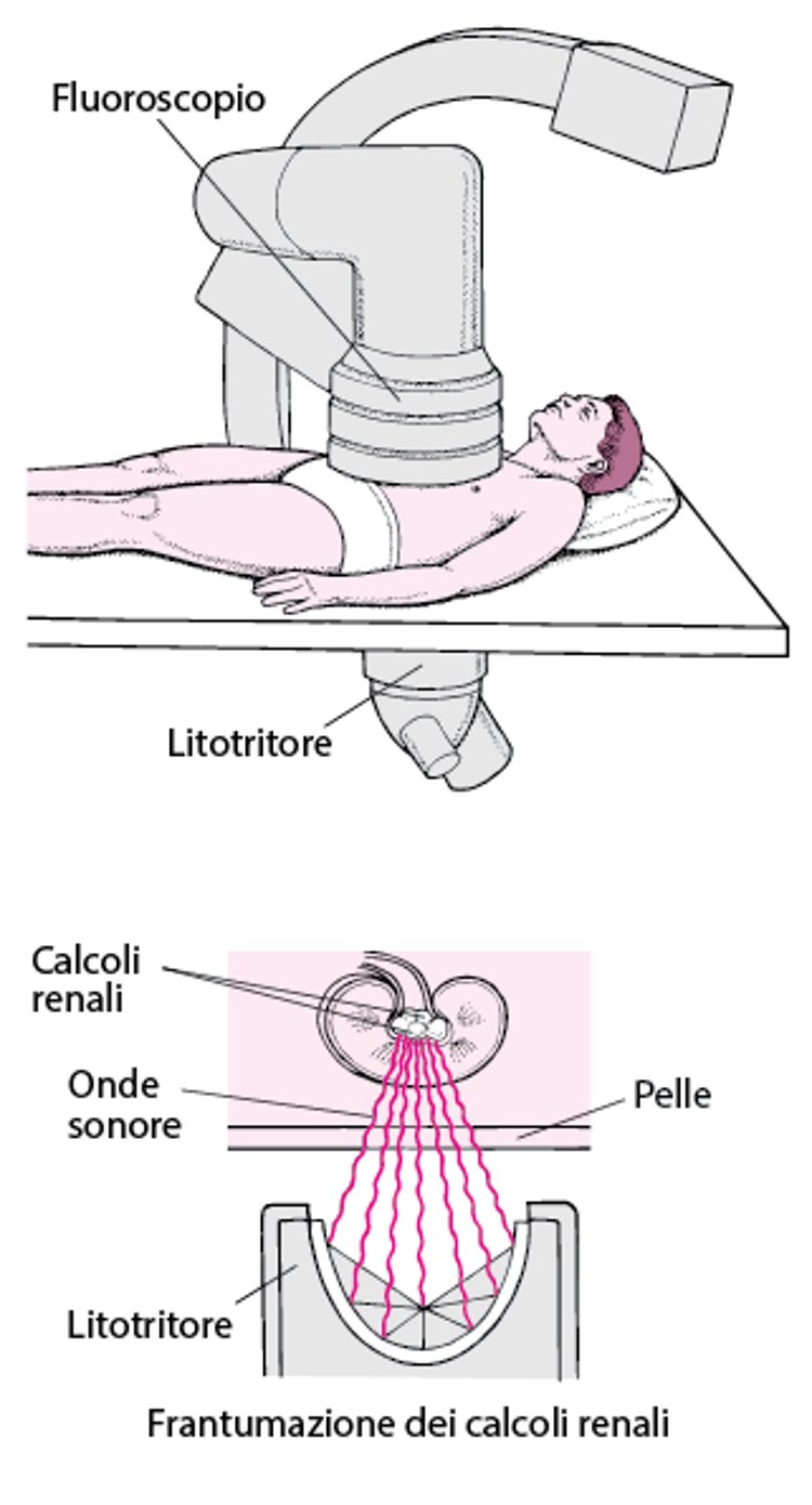 Frantumazione di un calcolo con onde d’urto
