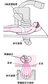 音波による結石の除去